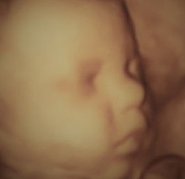 3D ultrasound image of baby